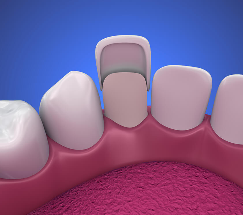 illustration of a dental veneer