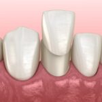 custom dental veneers, veneer creation process, veneers Oxford MS, cosmetic dentistry, porcelain veneers, dental veneer placement